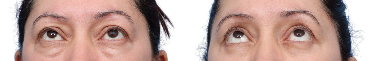 Blepharoplasty (Eyelid Surgery) Before & After Gallery - Patient 496545 - Image 3