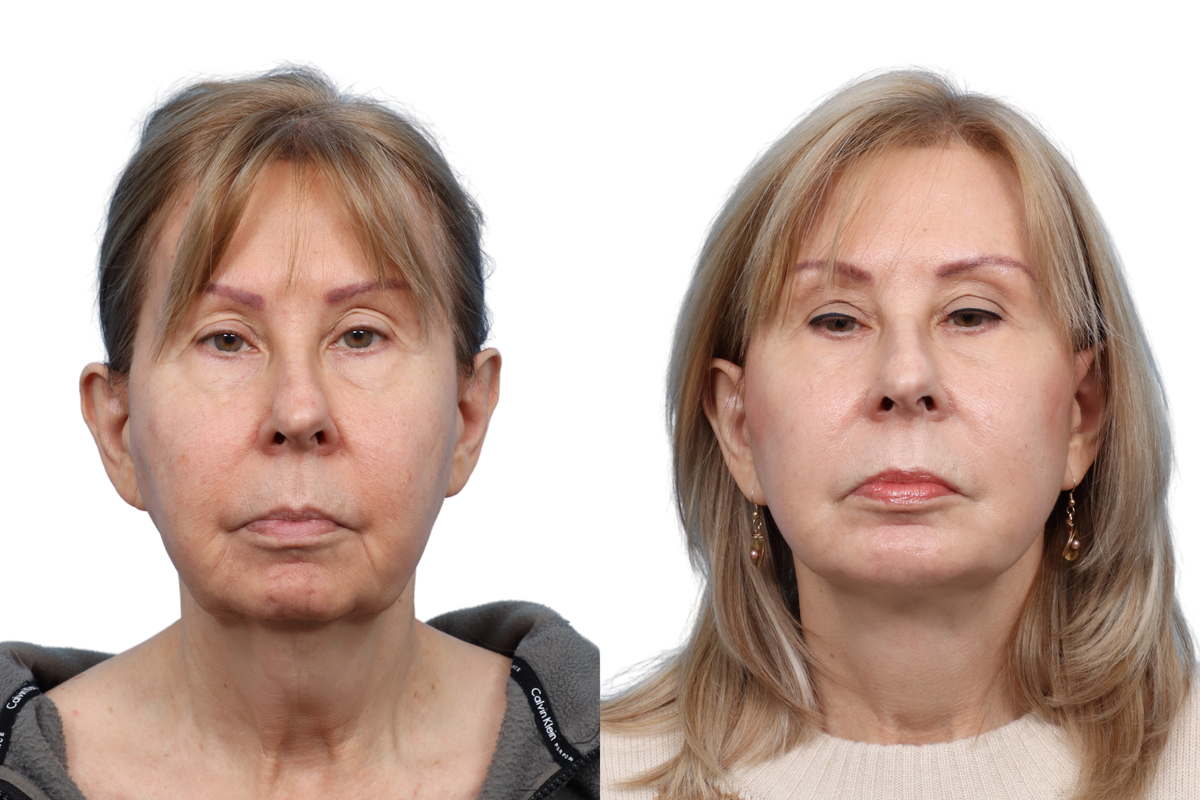 Deep Plane Facelift Before & After Gallery - Patient 418168 - Image 1