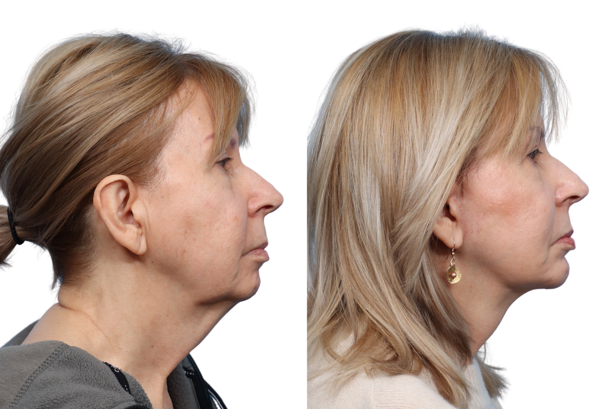 Deep Plane Facelift Before & After Gallery - Patient 418168 - Image 2
