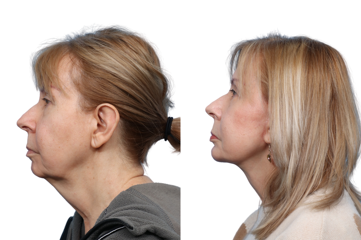 Deep Plane Facelift Before & After Gallery - Patient 418168 - Image 3