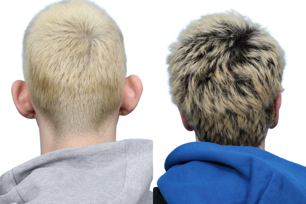 Otoplasty (Ear Surgery) Before & After Gallery - Patient 275985 - Image 1