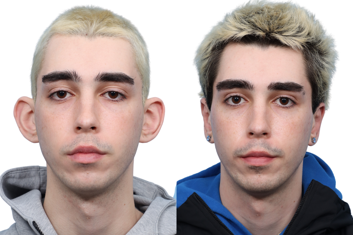 Otoplasty (Ear Surgery) Before & After Gallery - Patient 275985 - Image 2