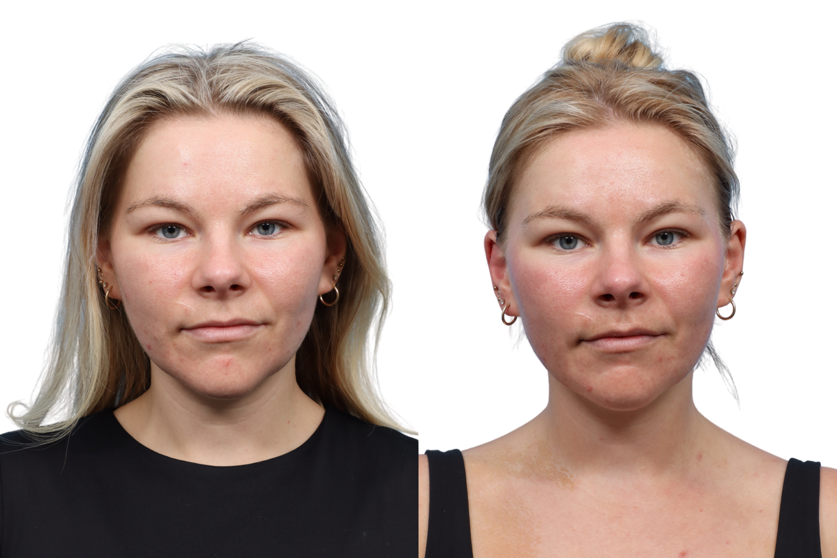 XERF Before & After Gallery - Patient 891835 - Image 1