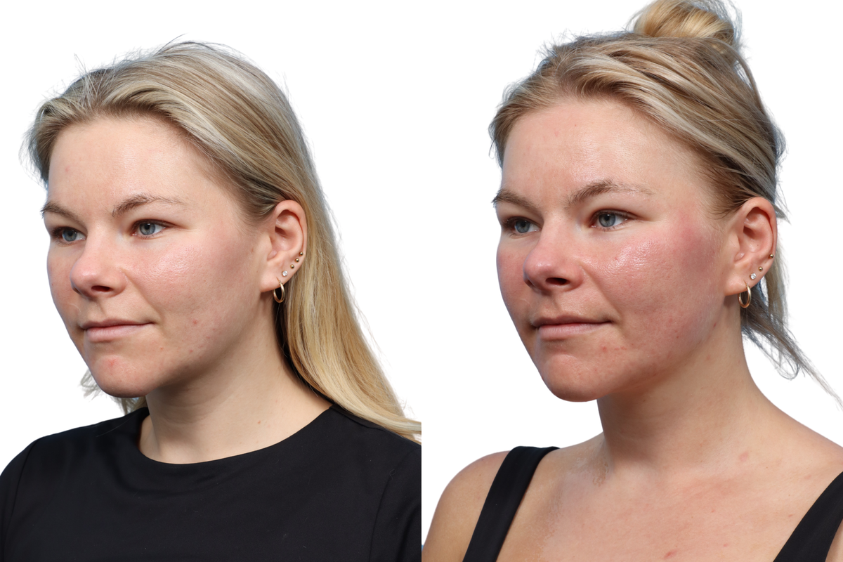 XERF Before & After Gallery - Patient 891835 - Image 2