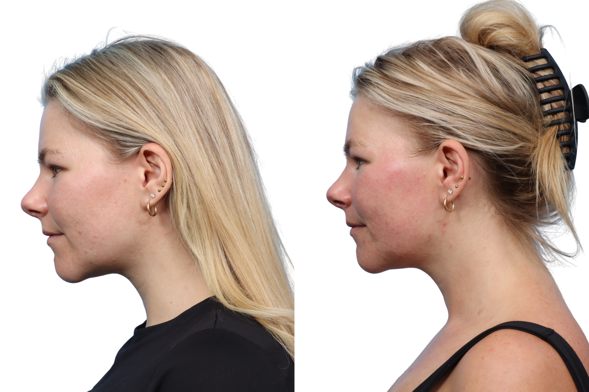 XERF Before & After Gallery - Patient 891835 - Image 3