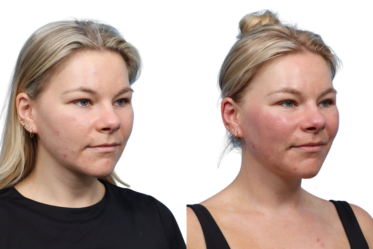XERF Before & After Gallery - Patient 891835 - Image 4