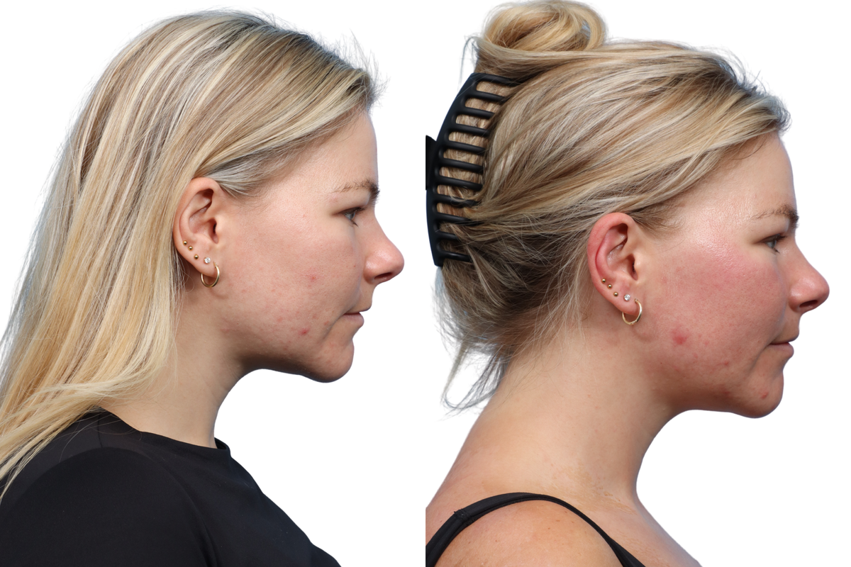 XERF Before & After Gallery - Patient 891835 - Image 5