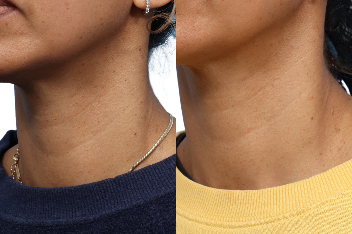 Picoway® Before & After Gallery - Patient 180399 - Image 1