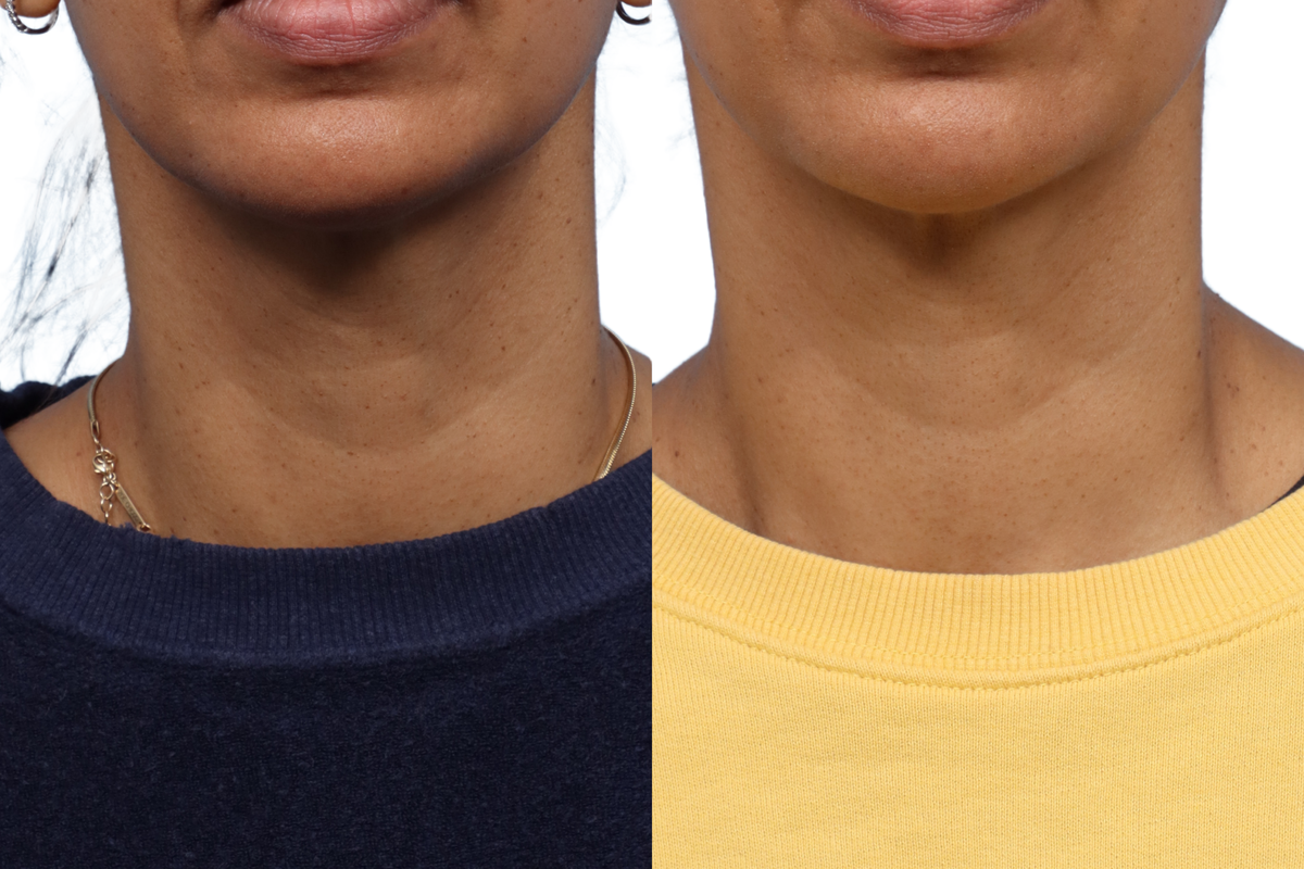 Picoway® Before & After Gallery - Patient 180399 - Image 2