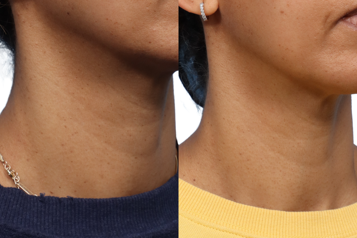 Picoway® Before & After Gallery - Patient 180399 - Image 3