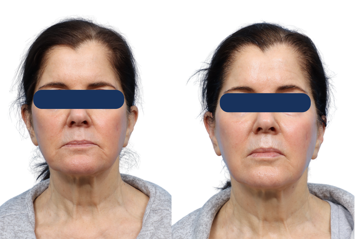 XERF Before & After Gallery - Patient 606035 - Image 1