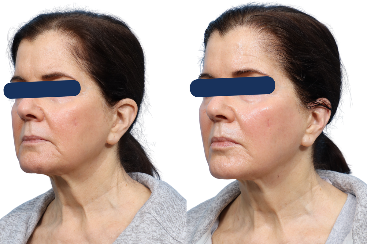 XERF Before & After Gallery - Patient 606035 - Image 2