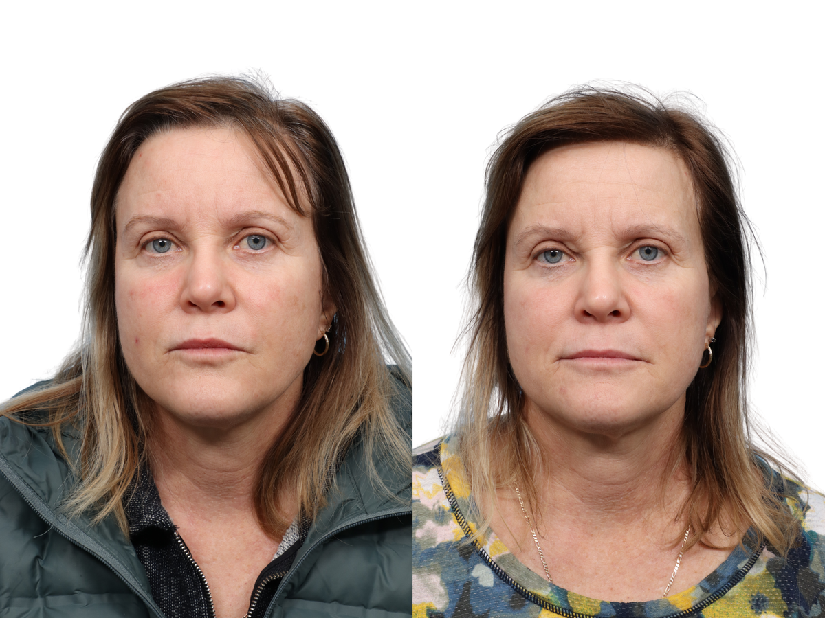 Ultralase Before & After Gallery - Patient 159948 - Image 1