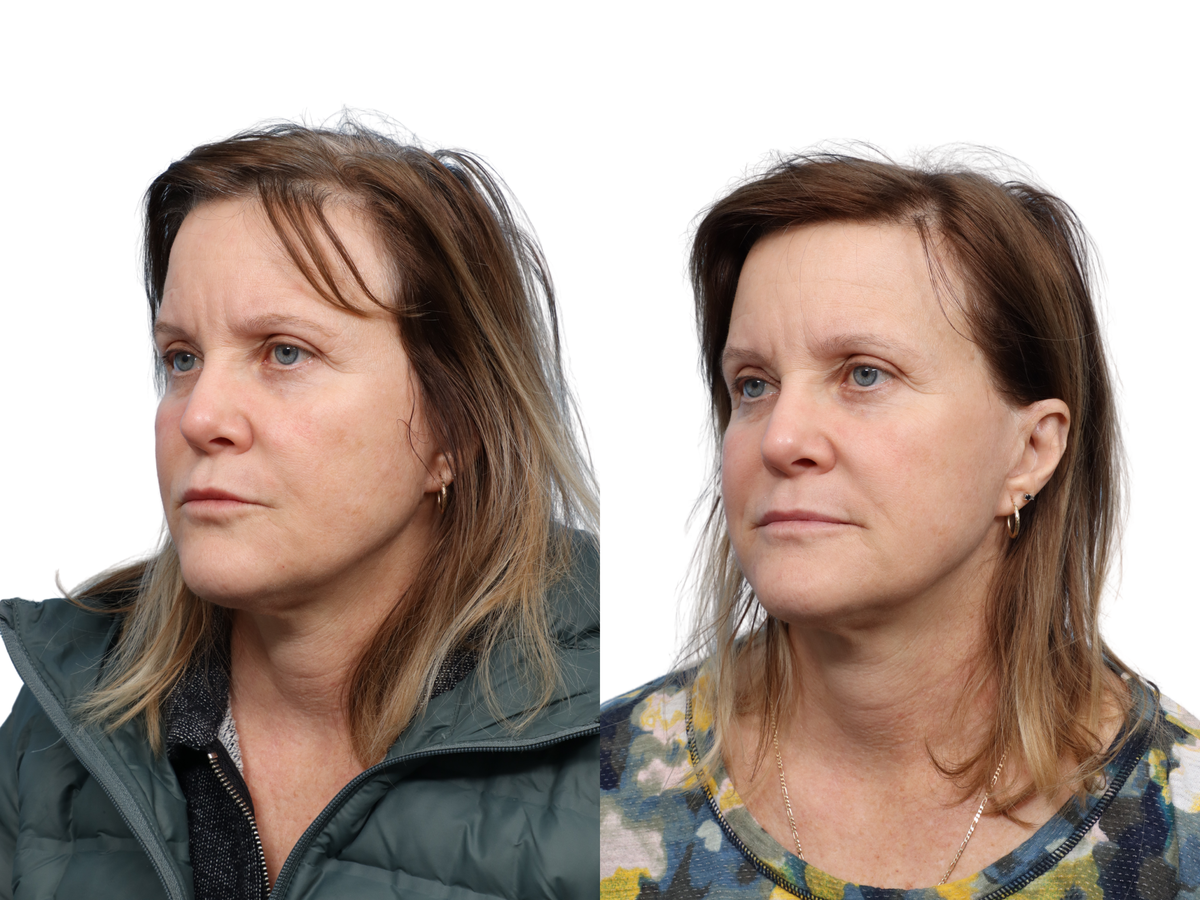 Ultralase Before & After Gallery - Patient 159948 - Image 2
