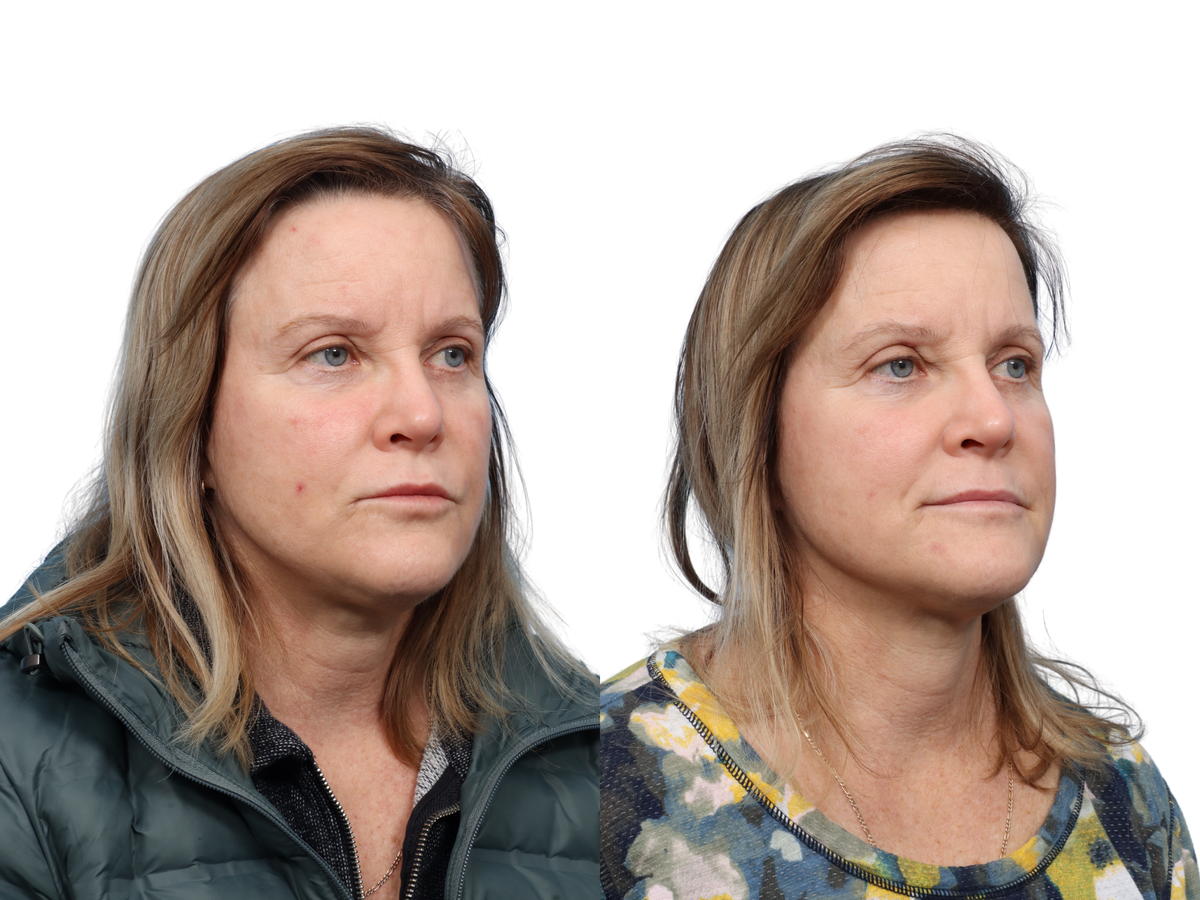 Ultralase Before & After Gallery - Patient 159948 - Image 3
