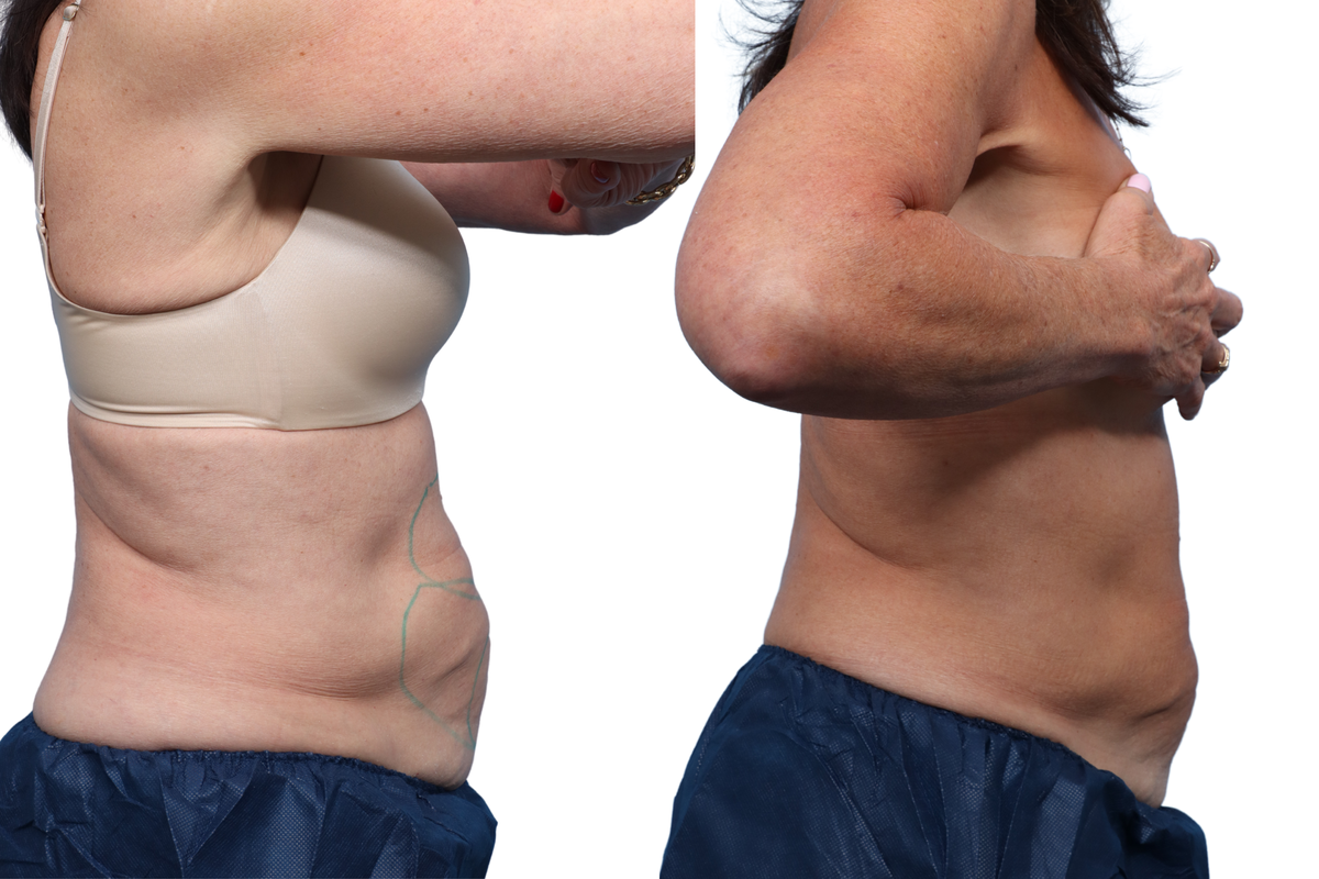 CoolSculpting® Before & After Gallery - Patient 319713 - Image 1