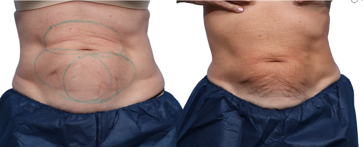 CoolSculpting® Before & After Gallery - Patient 319713 - Image 2