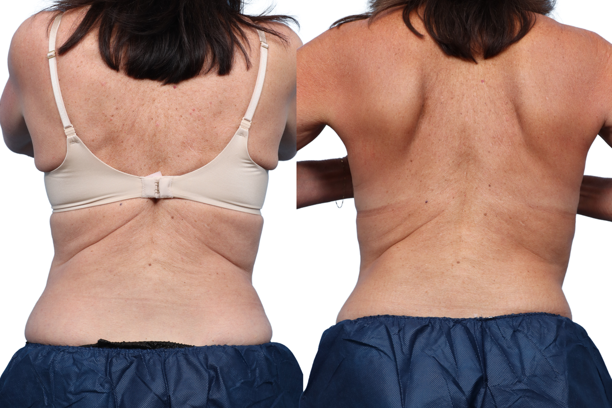 CoolSculpting® Before & After Gallery - Patient 319713 - Image 3