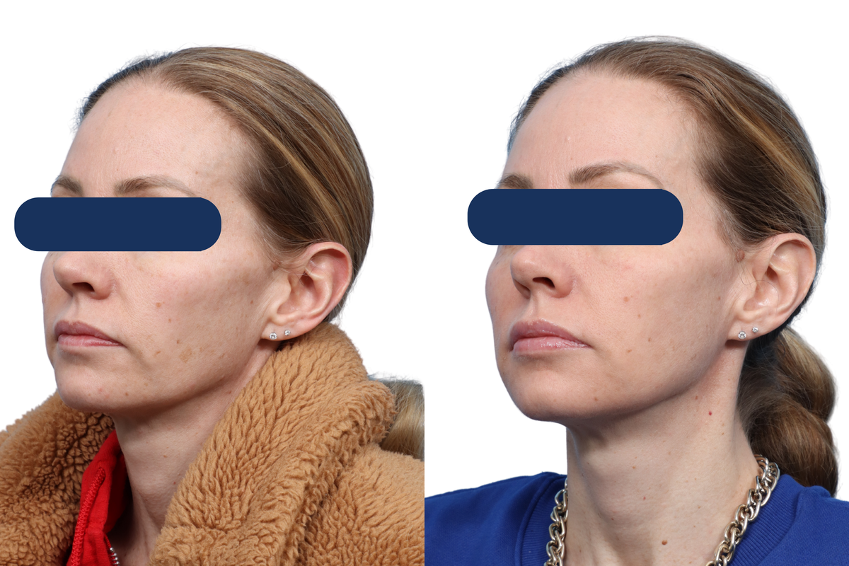 CO2 Laser Before & After Gallery - Patient 380453 - Image 1