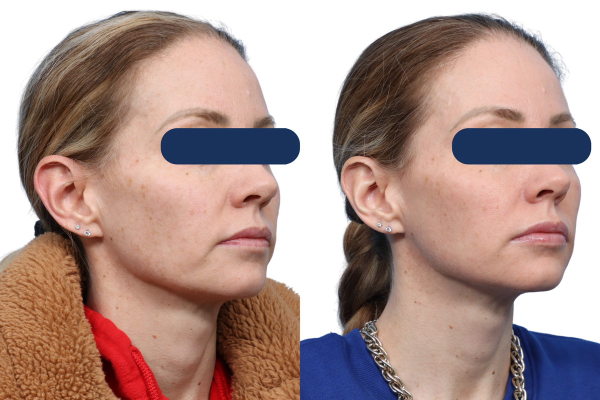 CO2 Laser Before & After Gallery - Patient 380453 - Image 2