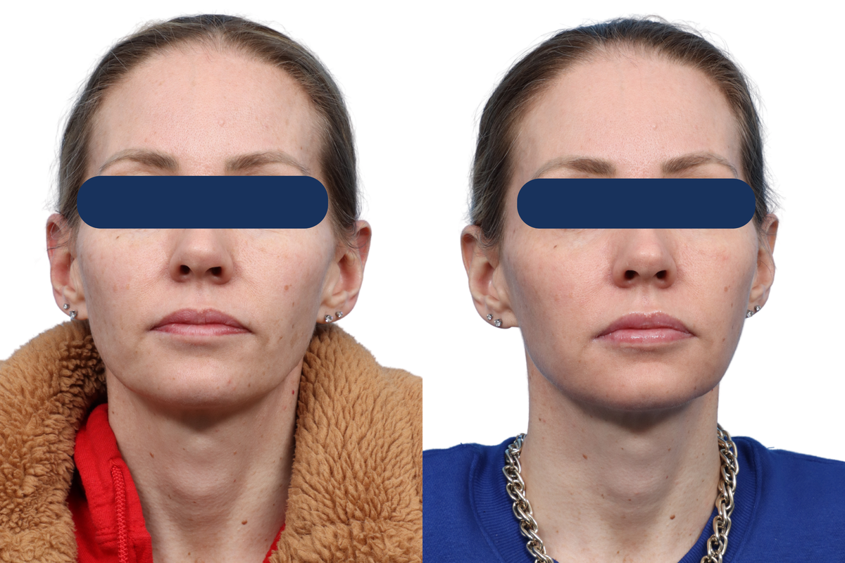 CO2 Laser Before & After Gallery - Patient 380453 - Image 3