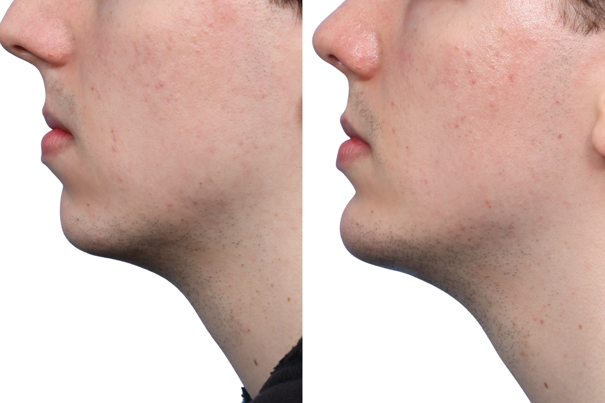 Chin Augmentation Before & After Gallery - Patient 367036 - Image 1