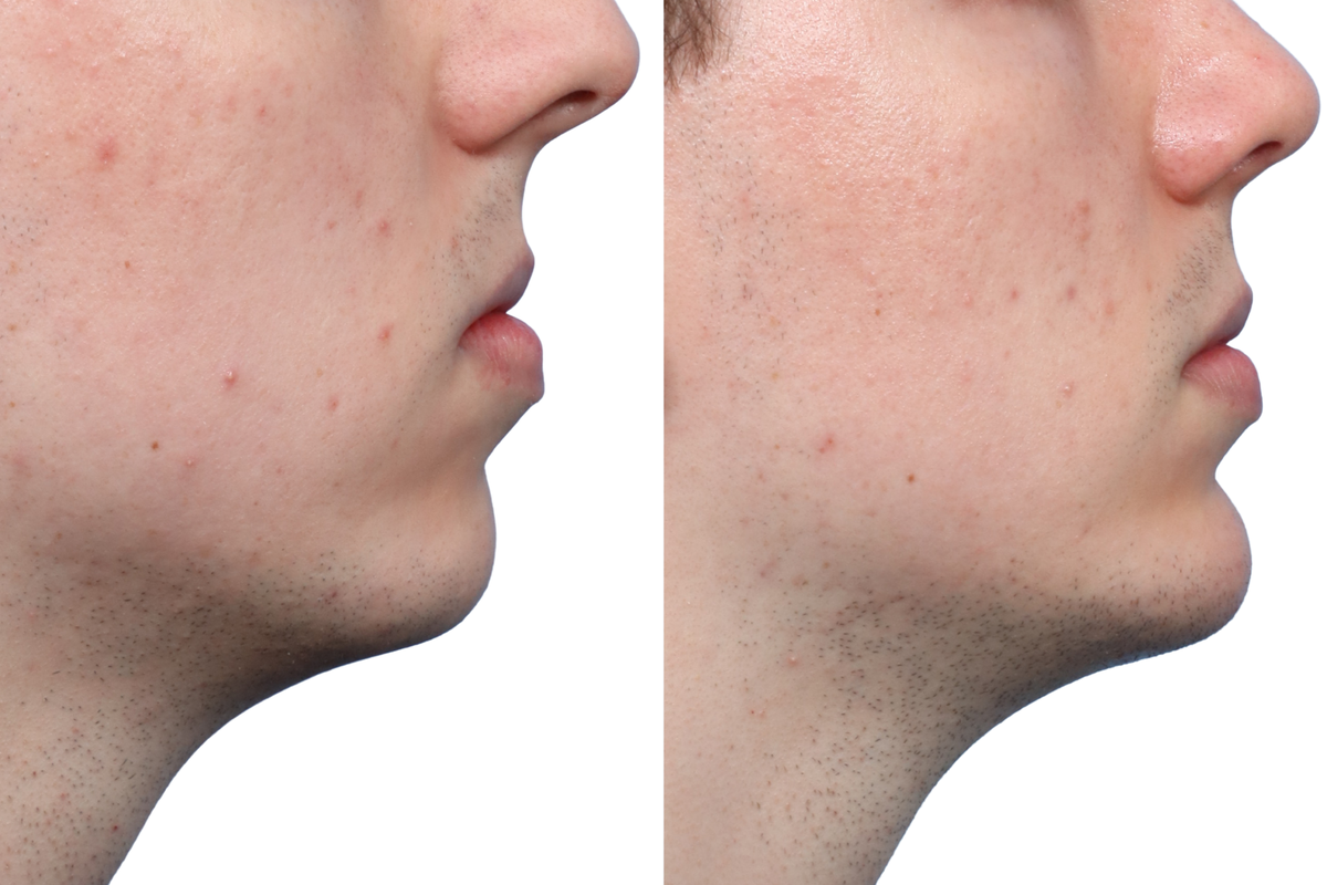 Chin Augmentation Before & After Gallery - Patient 367036 - Image 2