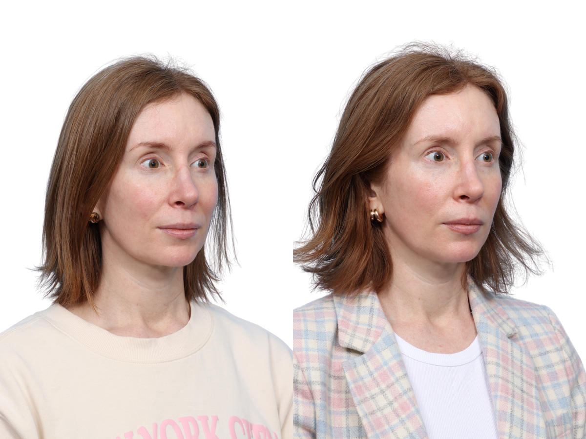 Ultralase Before & After Gallery - Patient 557186 - Image 1