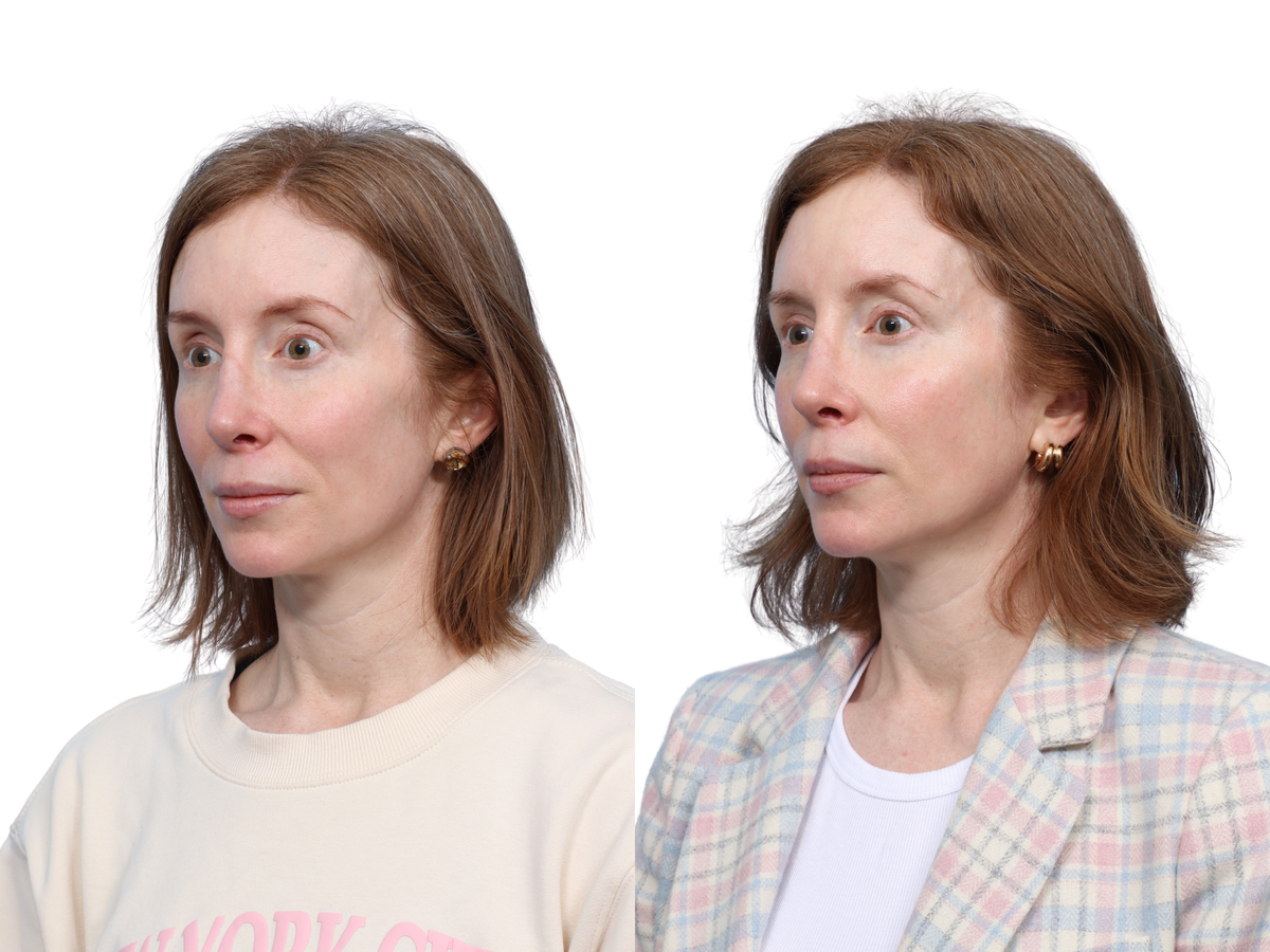 Ultralase Before & After Gallery - Patient 557186 - Image 2