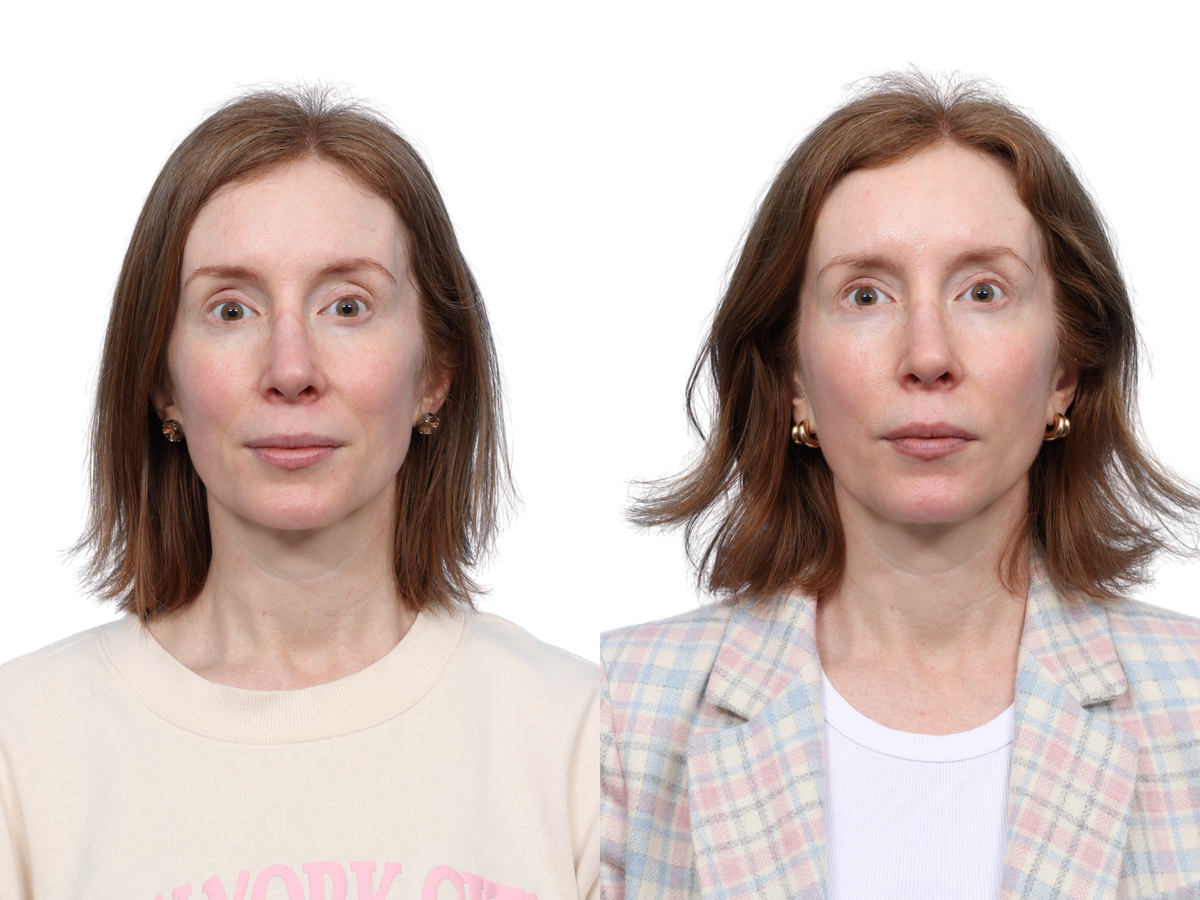 Ultralase Before & After Gallery - Patient 557186 - Image 3