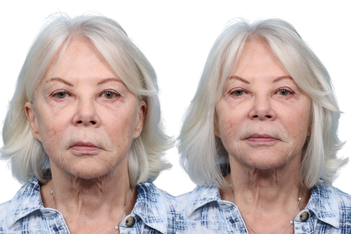 XERF Before & After Gallery - Patient 834614 - Image 1