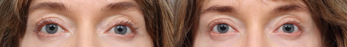 Blepharoplasty (Eyelid Surgery) Before & After Gallery - Patient 999477 - Image 1