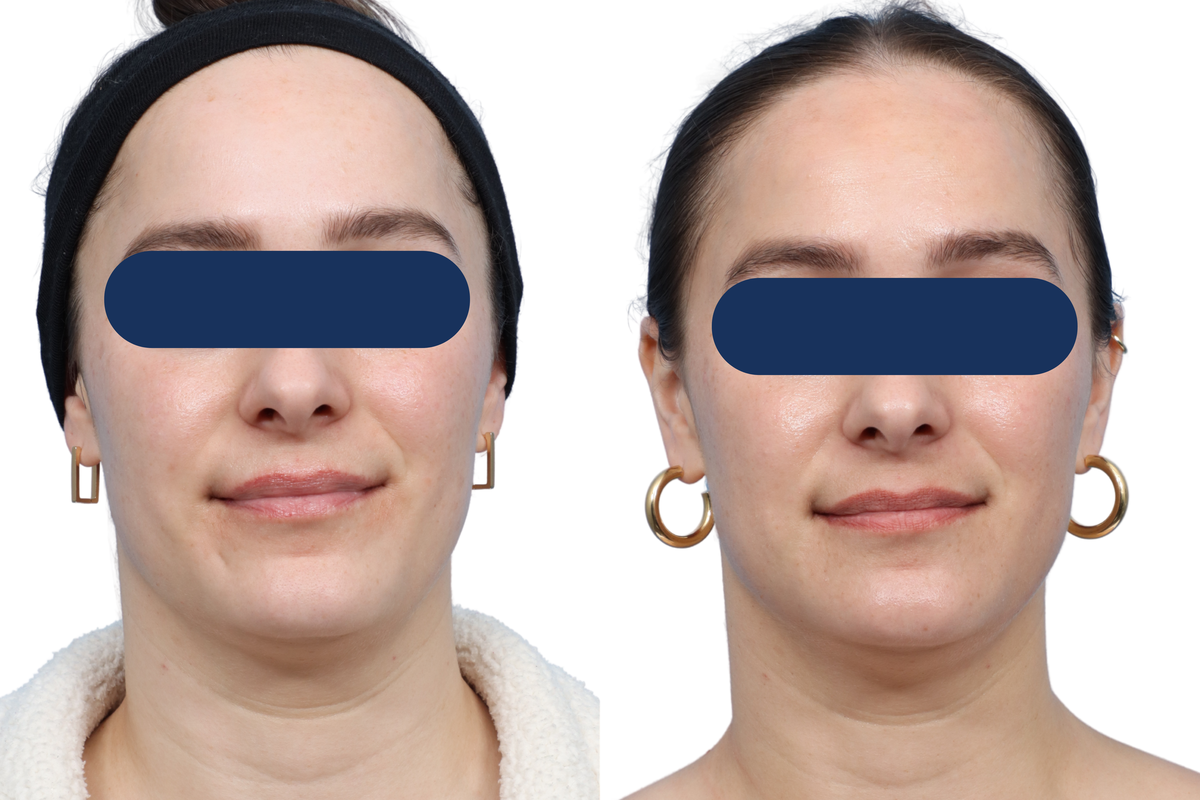 VBeam® Before & After Gallery - Patient 124798 - Image 1