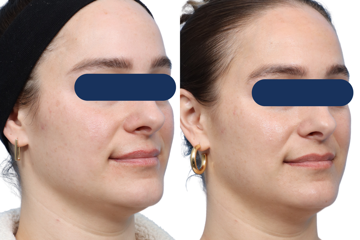 VBeam® Before & After Gallery - Patient 124798 - Image 2