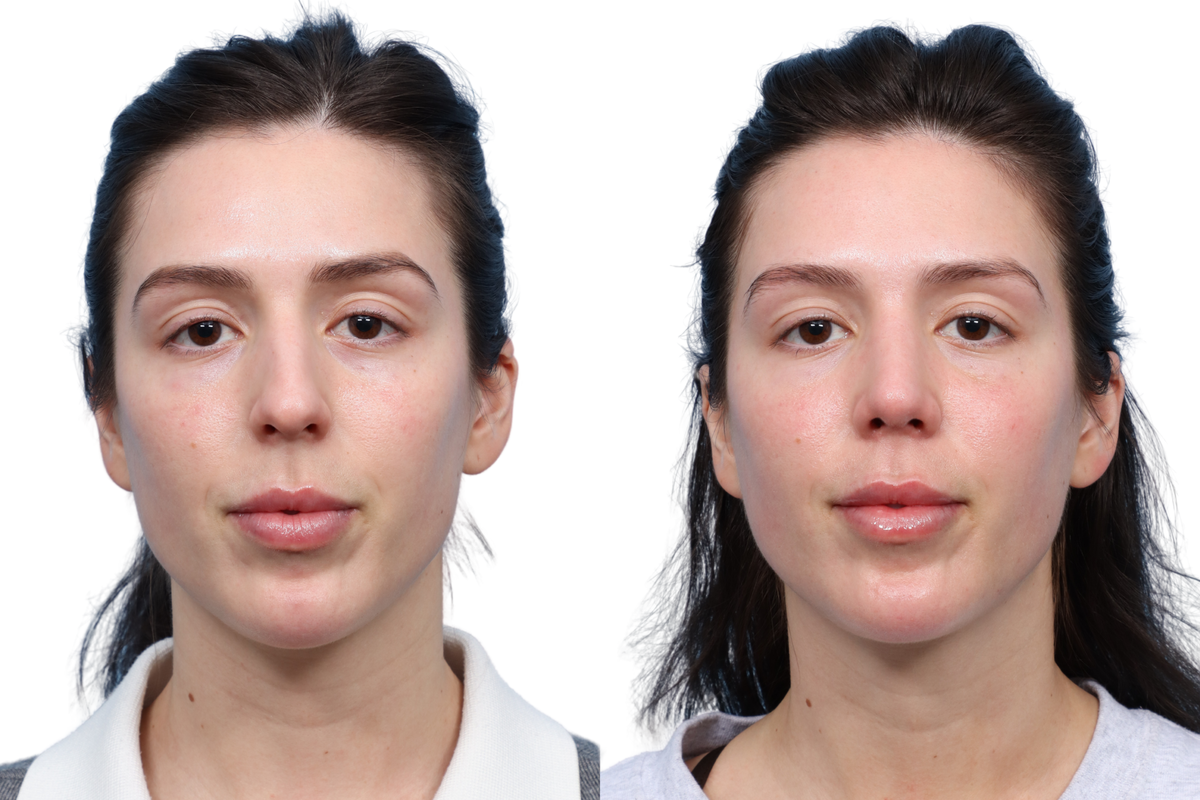 Rhinoplasty Before & After Gallery - Patient 455033 - Image 1