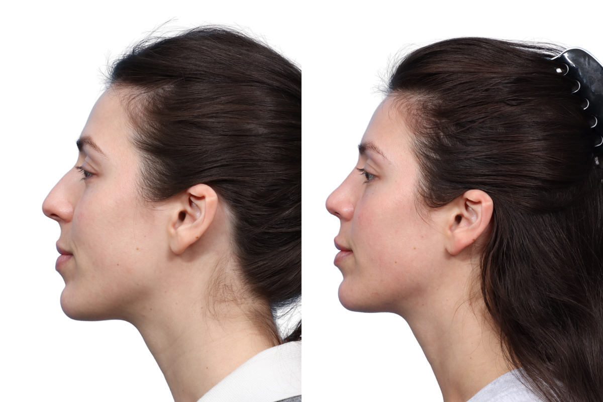 Rhinoplasty Before & After Gallery - Patient 455033 - Image 2