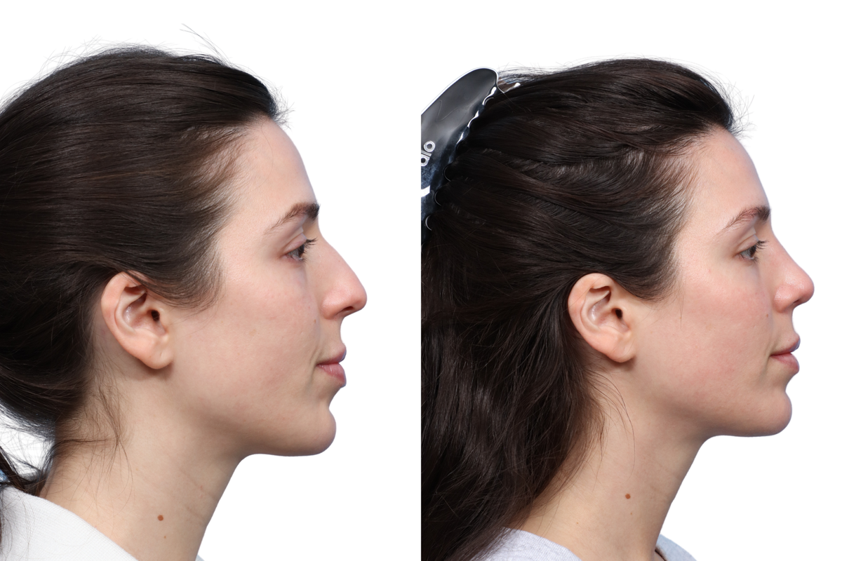 Rhinoplasty Before & After Gallery - Patient 455033 - Image 3