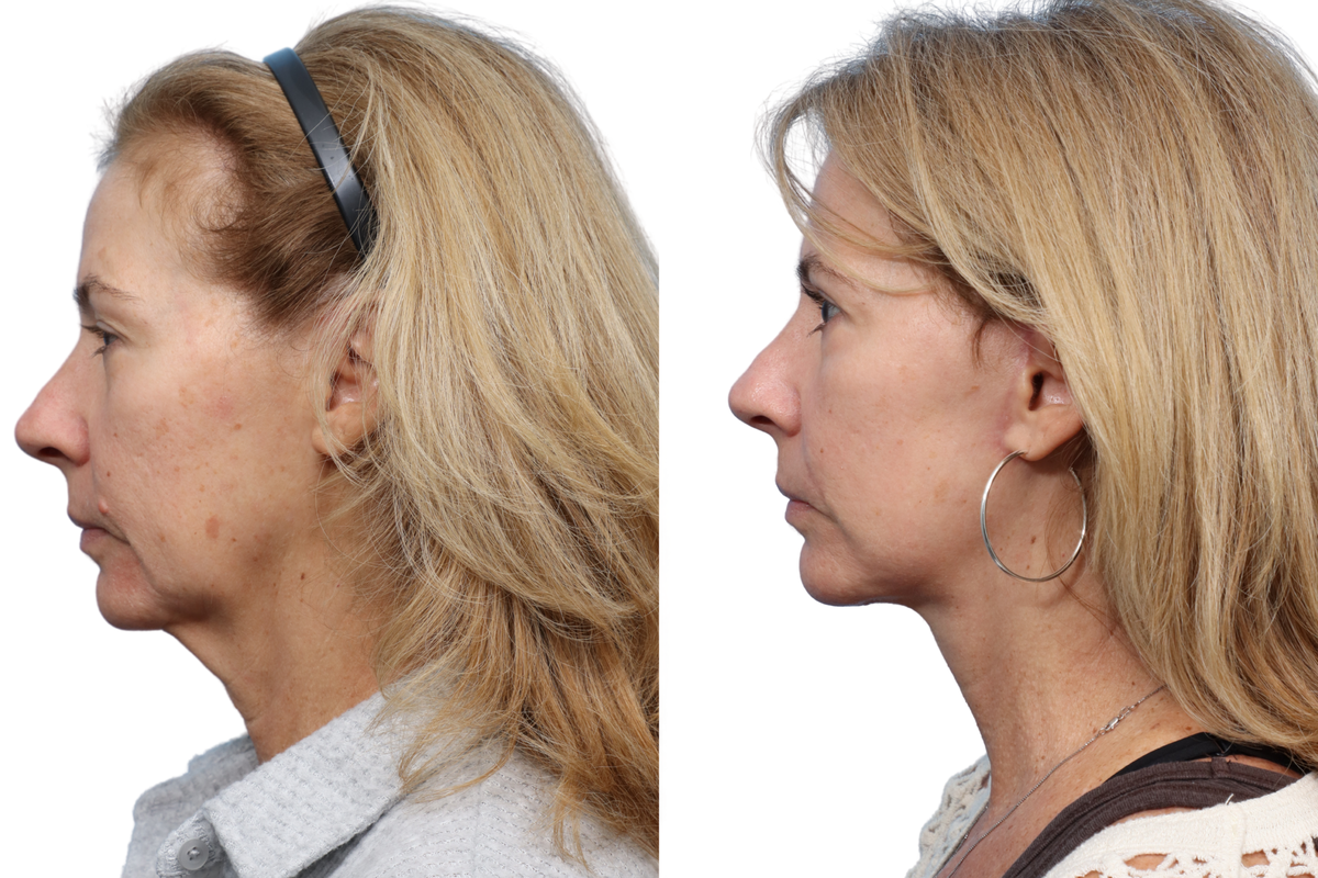 Deep Plane Facelift Before & After Gallery - Patient 532444 - Image 1