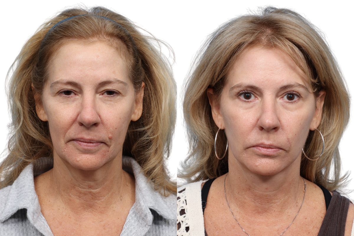 Deep Plane Facelift Before & After Gallery - Patient 532444 - Image 2
