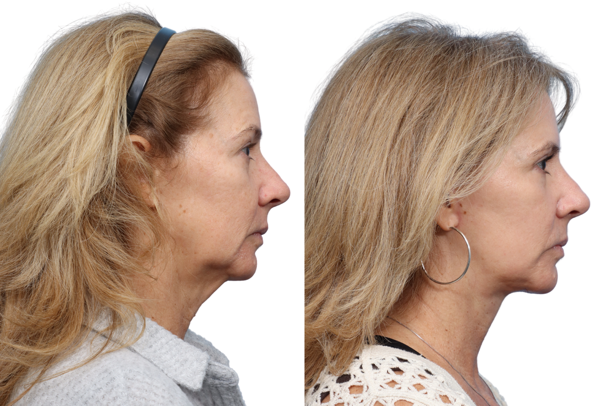 Deep Plane Facelift Before & After Gallery - Patient 532444 - Image 3