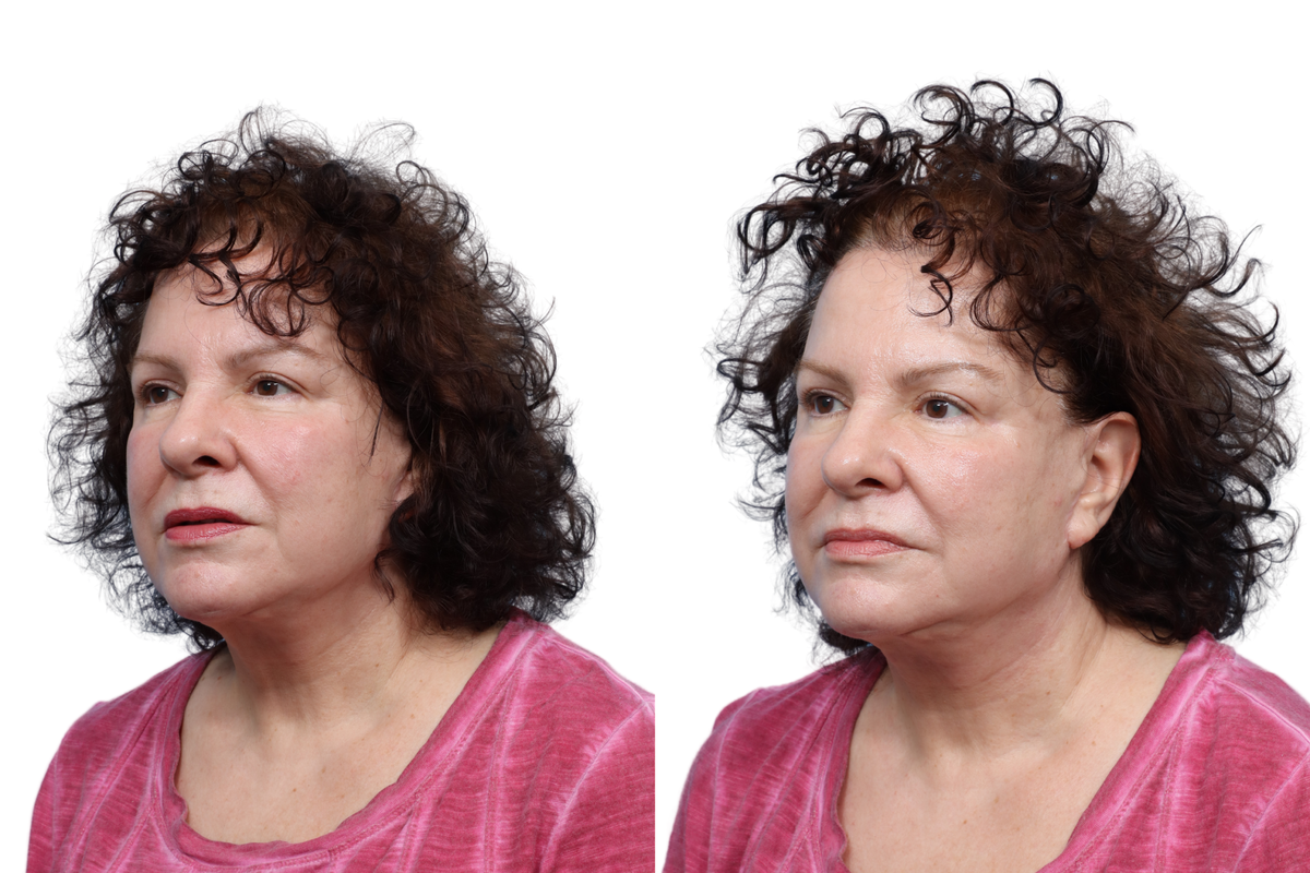 XERF Before & After Gallery - Patient 801438 - Image 1