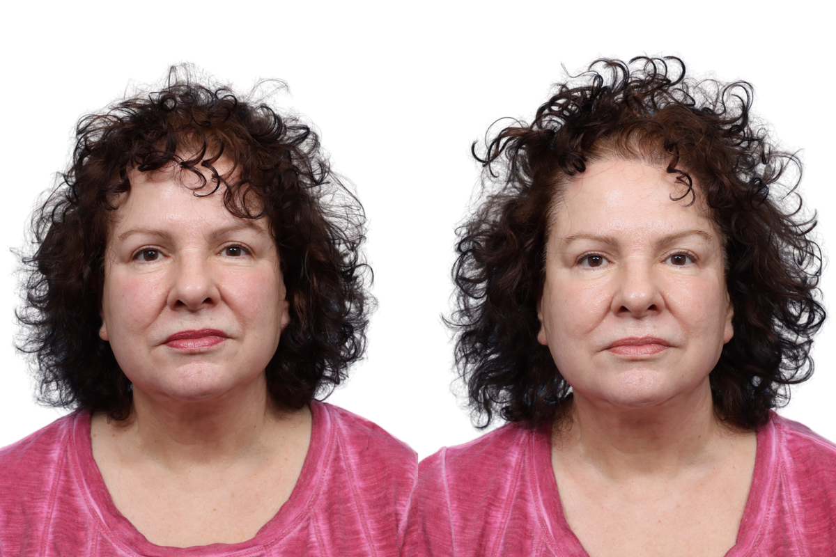 XERF Before & After Gallery - Patient 801438 - Image 2