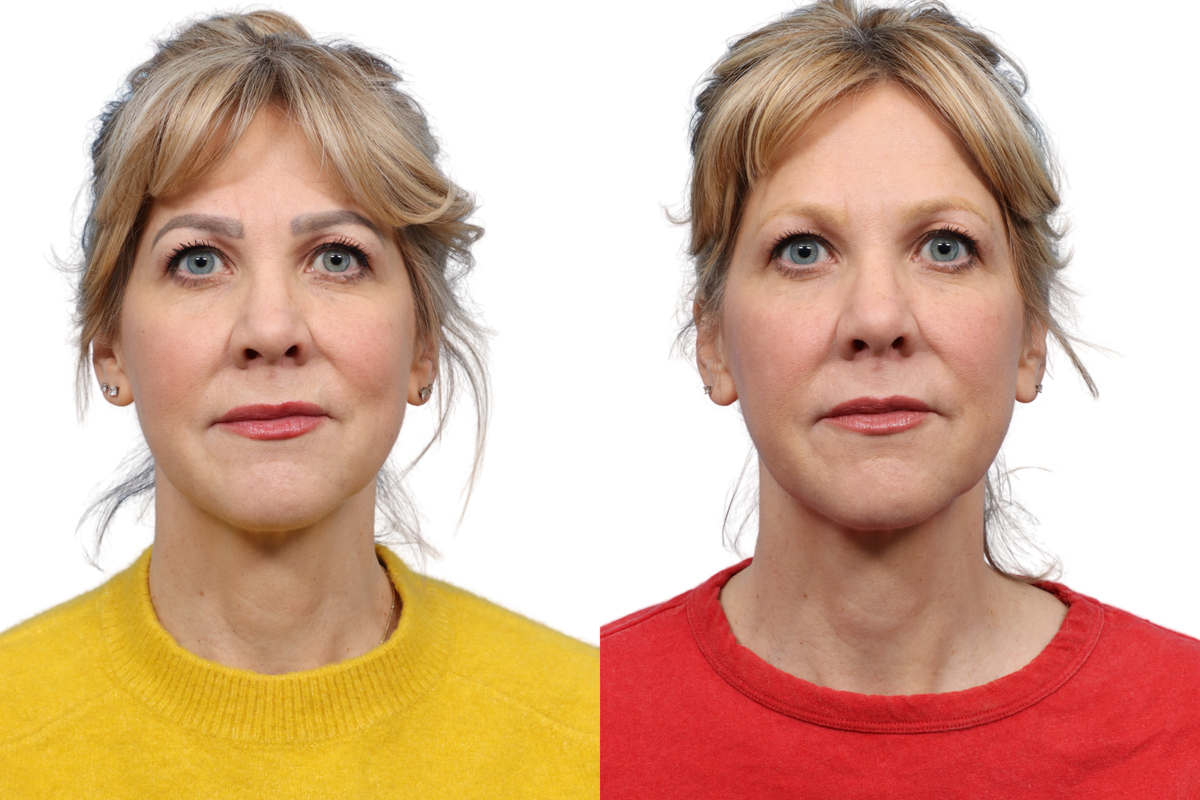 Tattoo Removal Before & After Gallery - Patient 991128 - Image 1