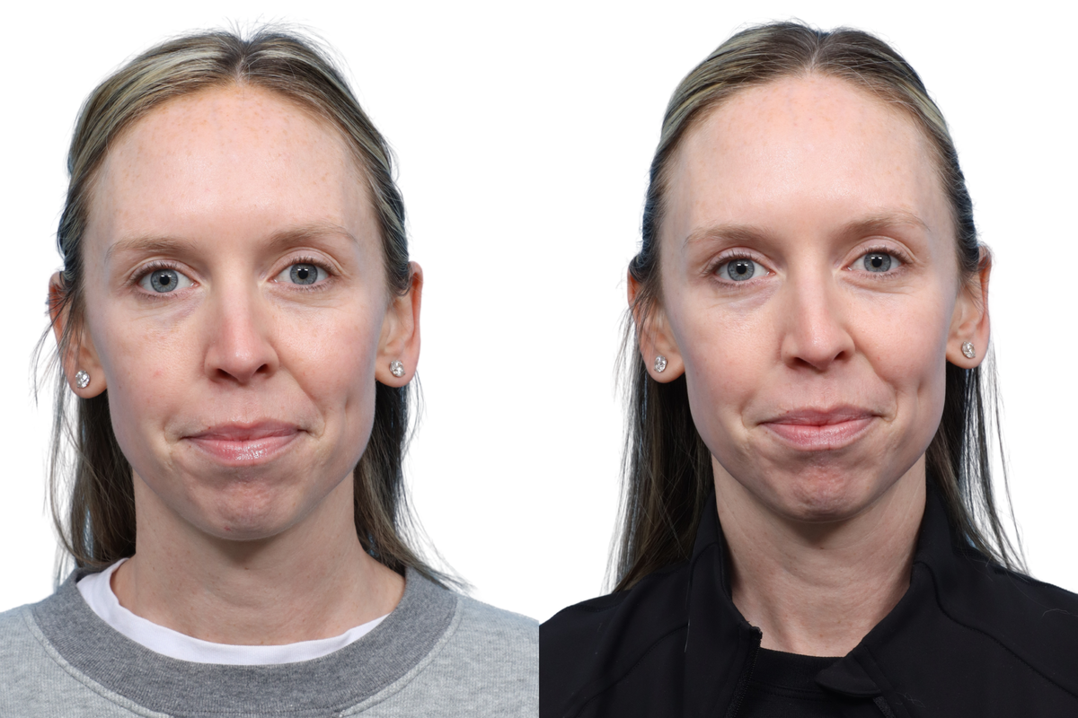 Ultralase Before & After Gallery - Patient 497827 - Image 1