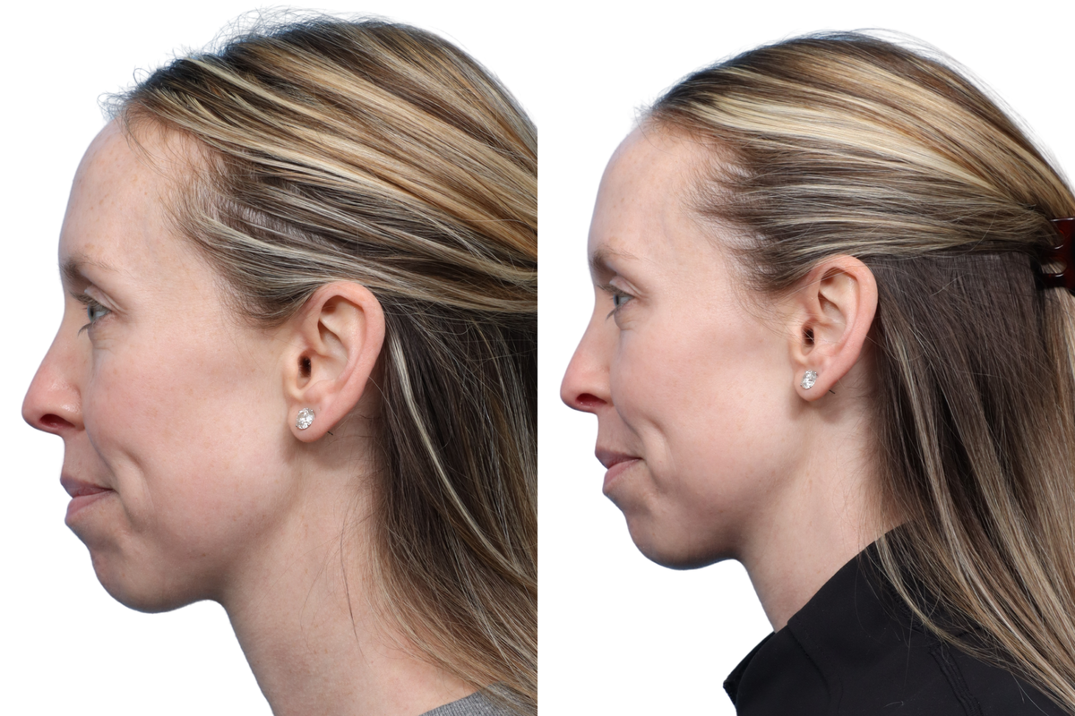 Ultralase Before & After Gallery - Patient 497827 - Image 2