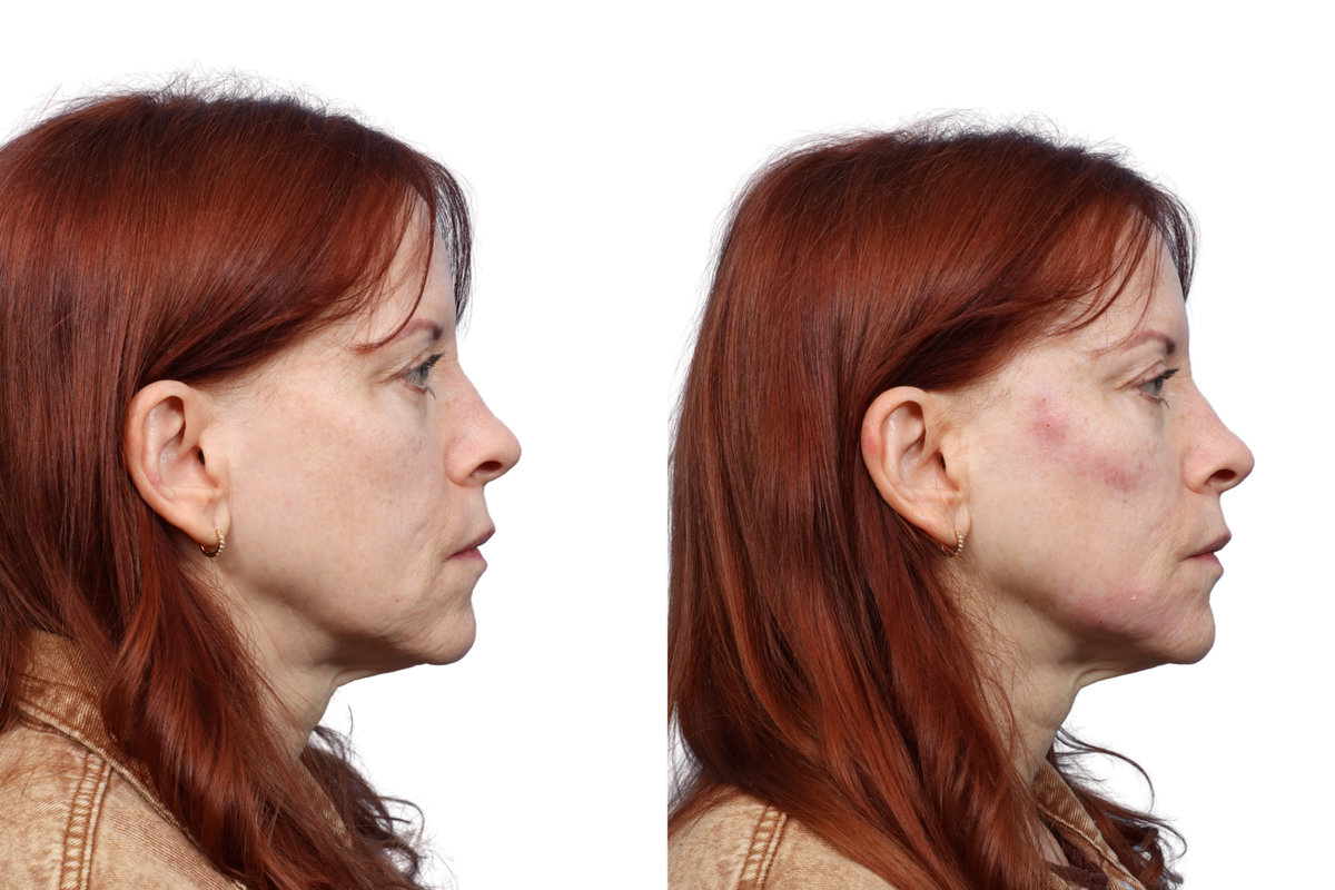 XERF Before & After Gallery - Patient 340753 - Image 1