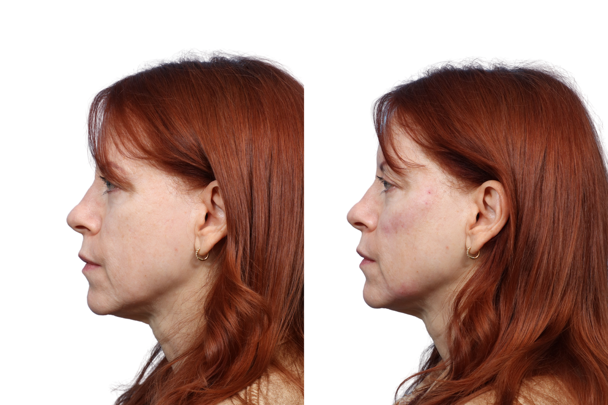 XERF Before & After Gallery - Patient 340753 - Image 2