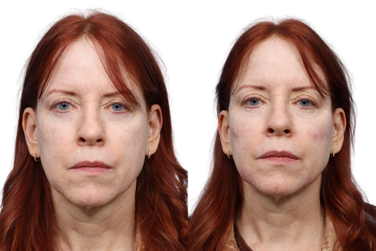 XERF Before & After Gallery - Patient 340753 - Image 3