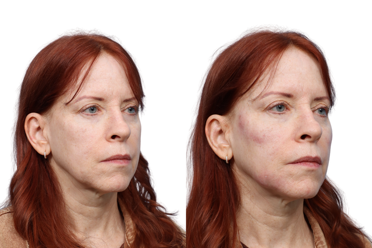XERF Before & After Gallery - Patient 340753 - Image 4