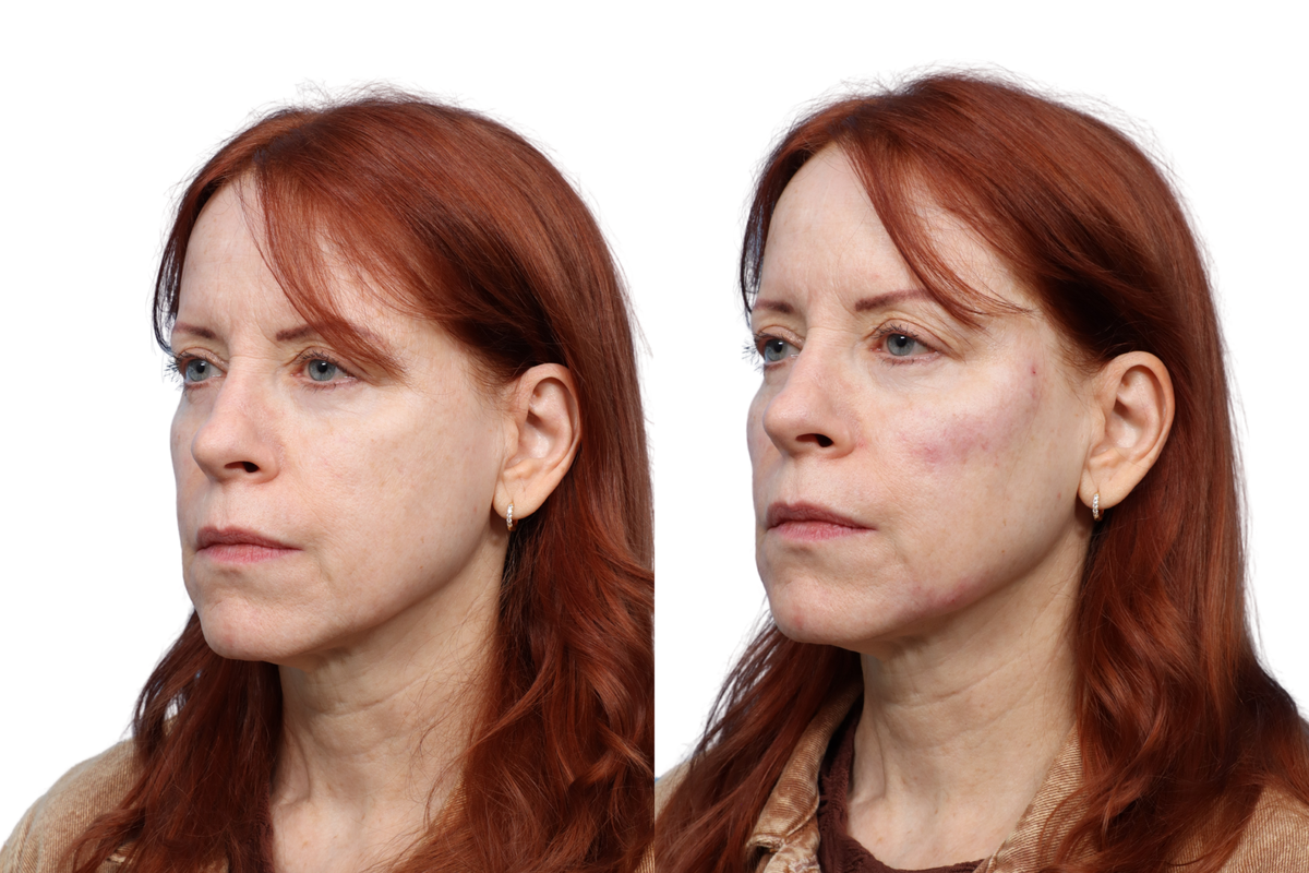 XERF Before & After Gallery - Patient 340753 - Image 5